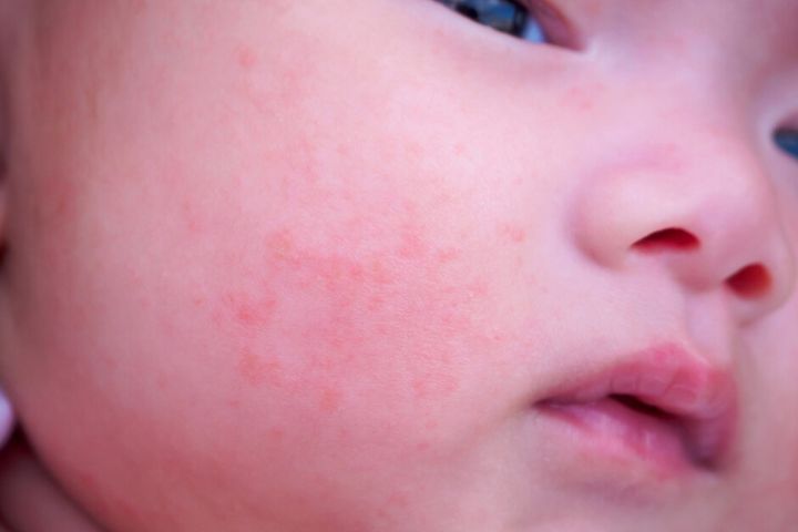 How to Prevent Food Allergies in Children