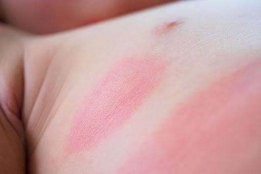 Infant Eczema - Possible Causes & Treatments